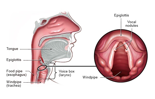 Vocal Nodules