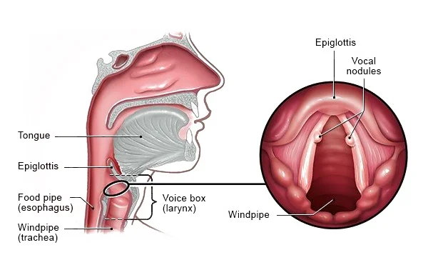 Vocal Nodules