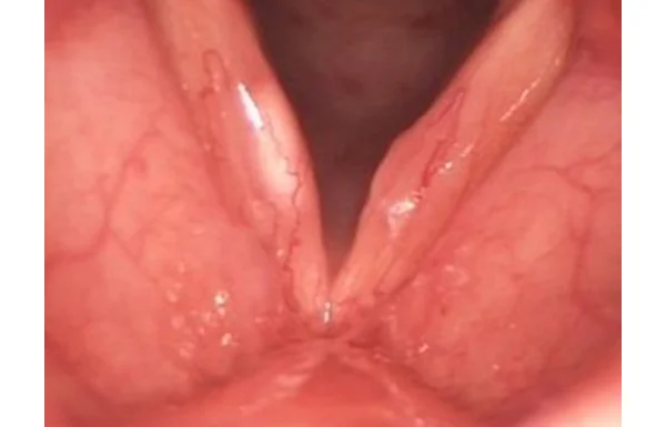 Cyst
