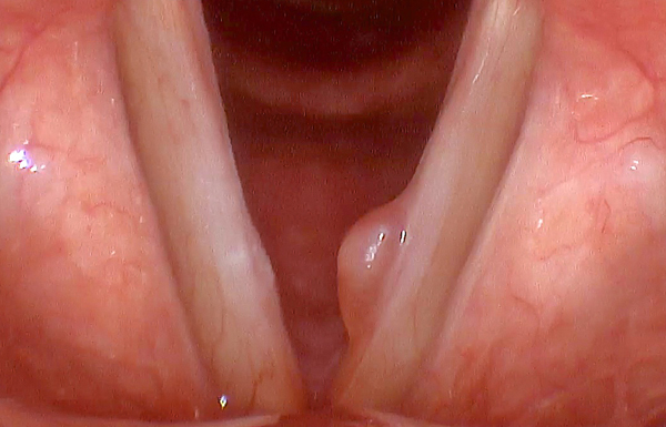 Polyp