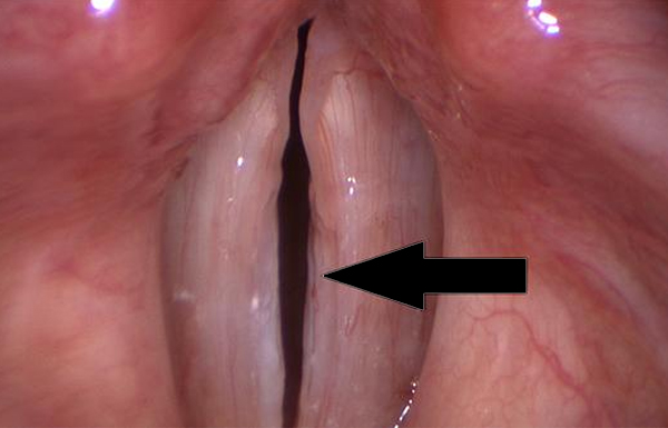Sulcus