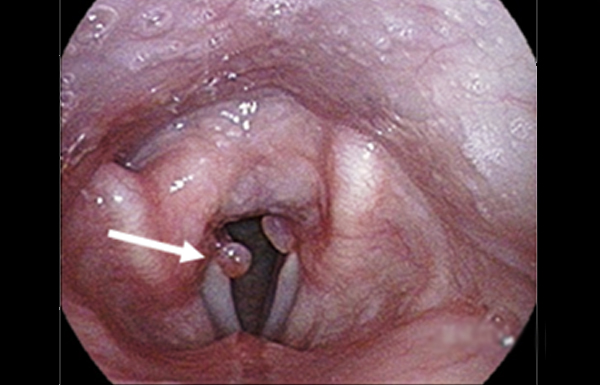 Granuloma