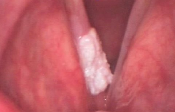 Leukoplakia