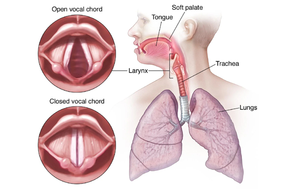 Acute Laryngitis