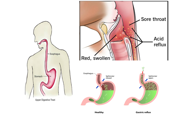 Laryngopharyngeal Reflux LPR