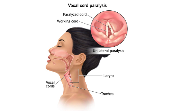 Paresis or Paralysis