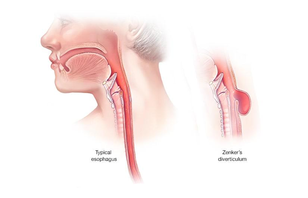 Zenkers Diverticulum