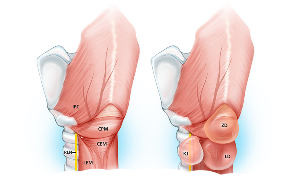 Cricopharyngeal Dysfunction