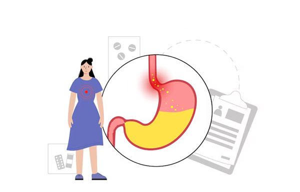 Esophageal Dysphagia