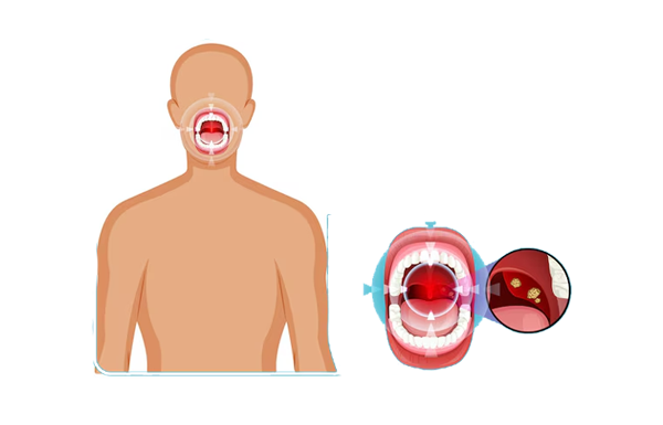 Achalasia
