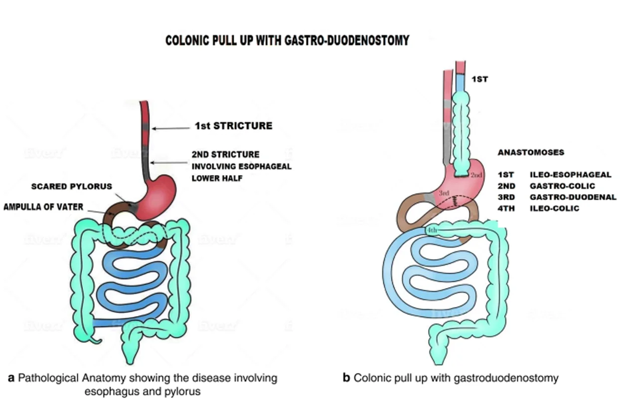 Esophageal Strictures