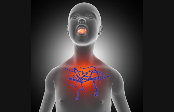 Eosinophilic Esophagitis
