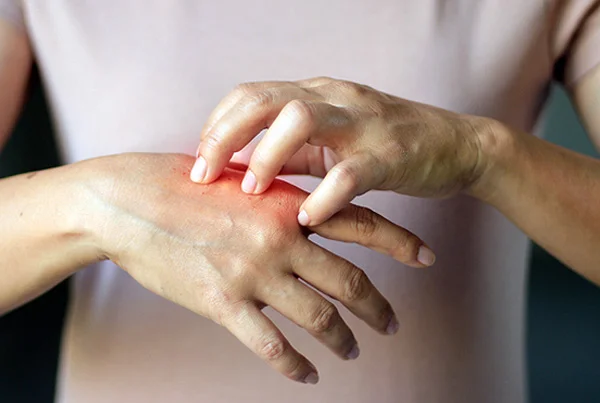 Scleroderma