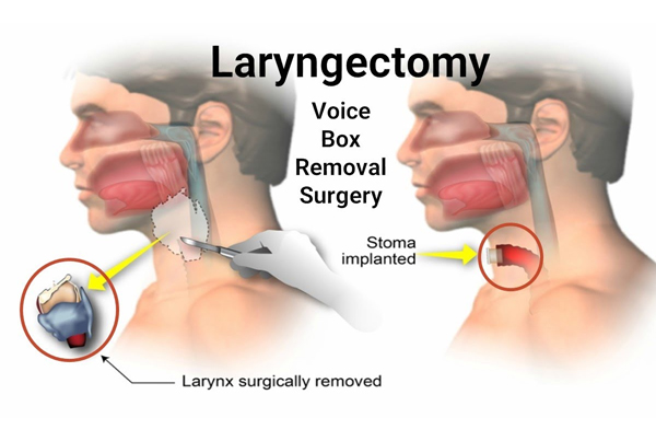 Laryngeal Cancer