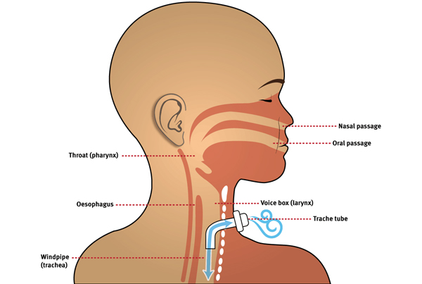 Tracheitis