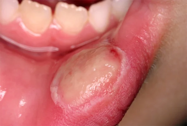 Throat Ulcers
