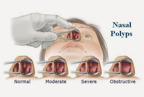 Nasal Polyps