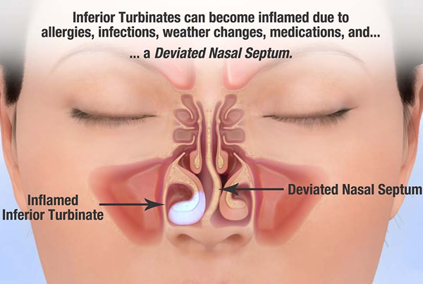Deviated Nasal Septum