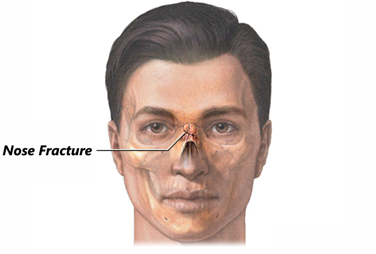 Nasal Fracture