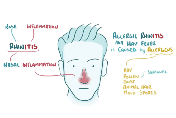 Allergic Rhinitis