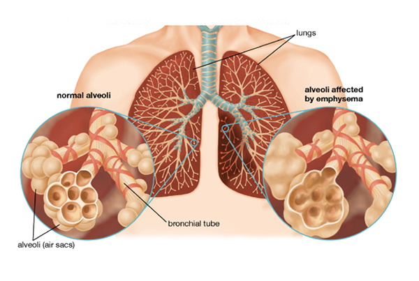 Emphysema