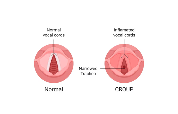 Laryngotracheobronchitis