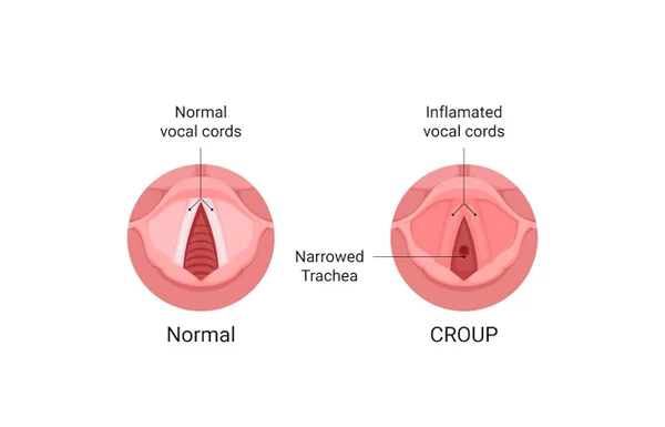 Laryngotracheobronchitis