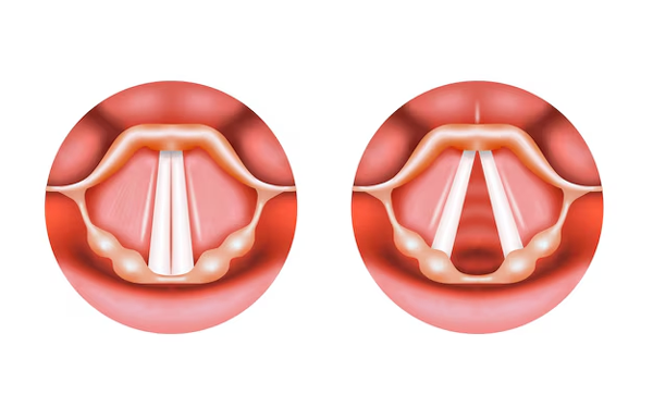 Vocal Cord Dysfunction
