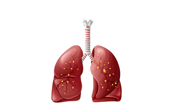 Pulmonary Fibrosis