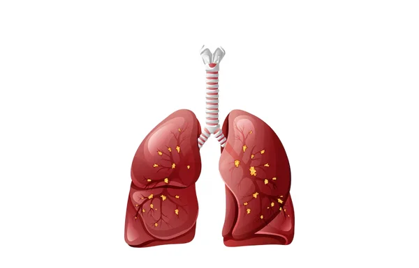 Pulmonary Fibrosis