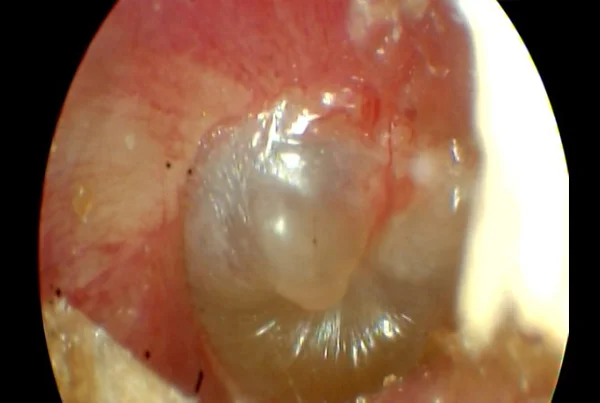 Otitis Media