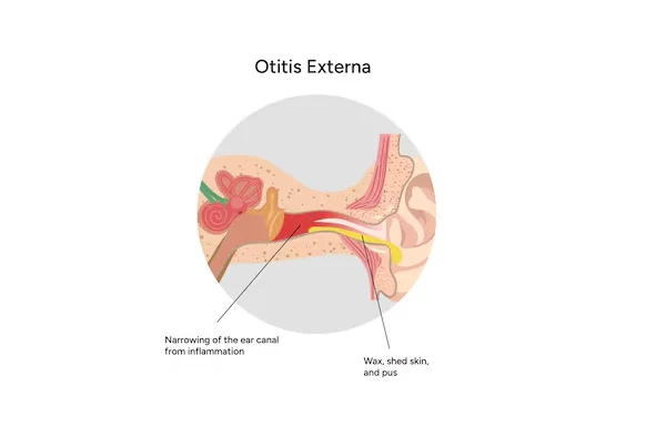 Otitis Externa
