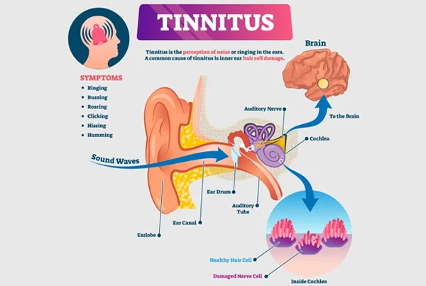 Tinnitus