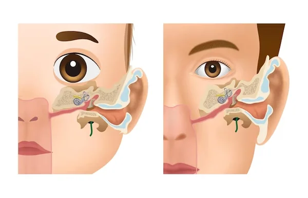 Eustachian Tube Dysfunction